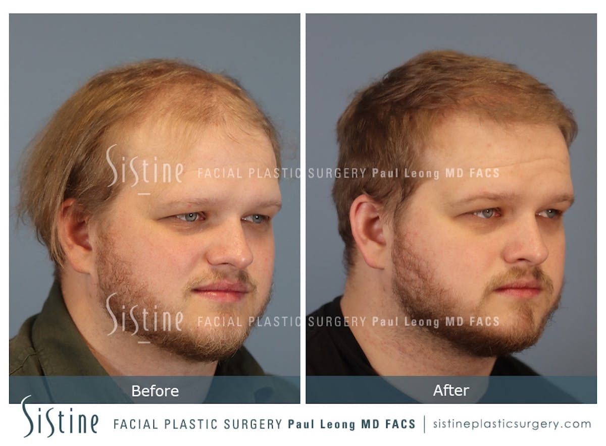 Hair Transplant Before & After Gallery - Patient 297398 - Image 3
