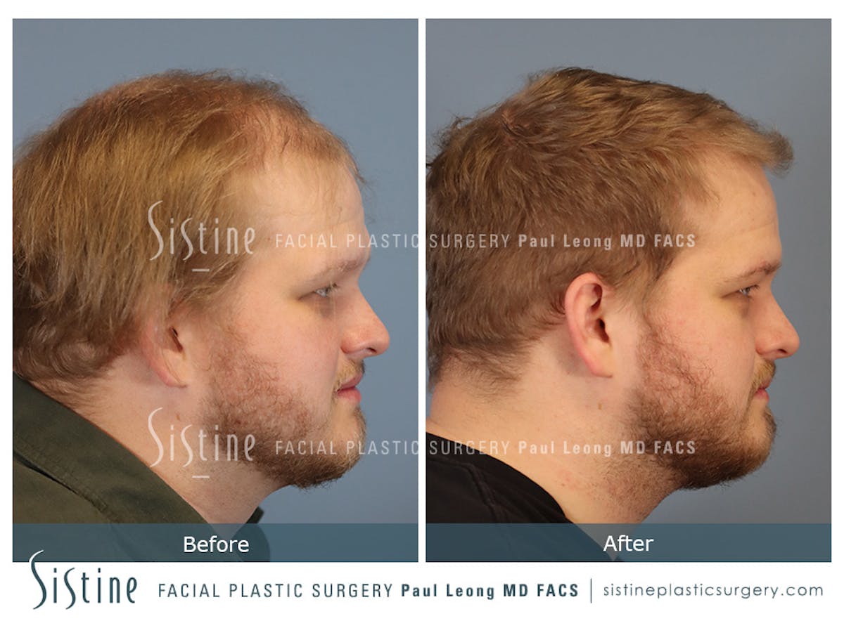 Hair Transplant Before & After Gallery - Patient 297398 - Image 4