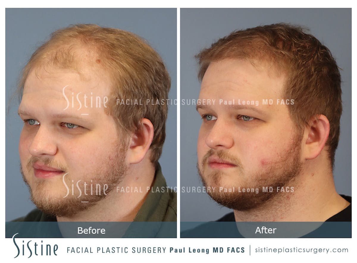 Hair Transplant Before & After Gallery - Patient 297398 - Image 5