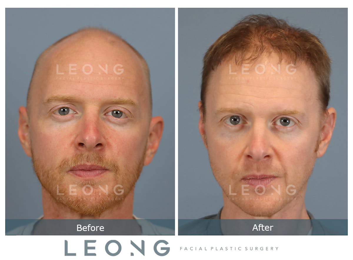 Hair Transplant Before & After Gallery - Patient 334614 - Image 1