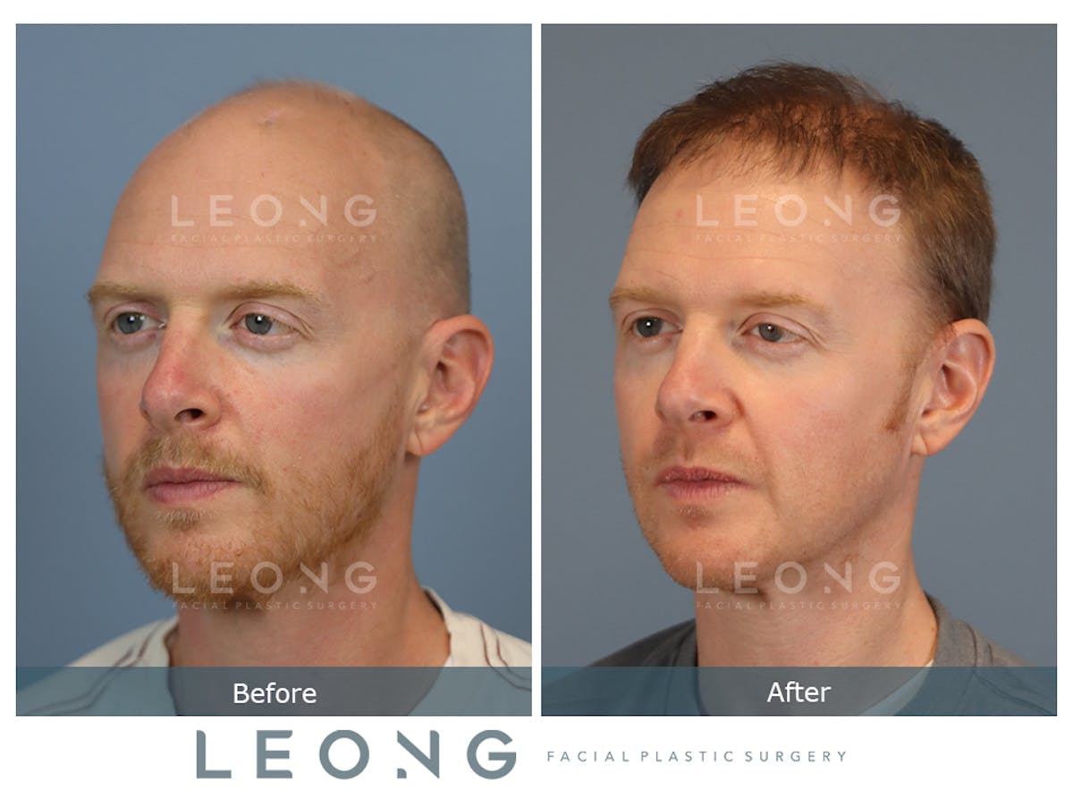 Hair Transplant Before & After Gallery - Patient 334614 - Image 4