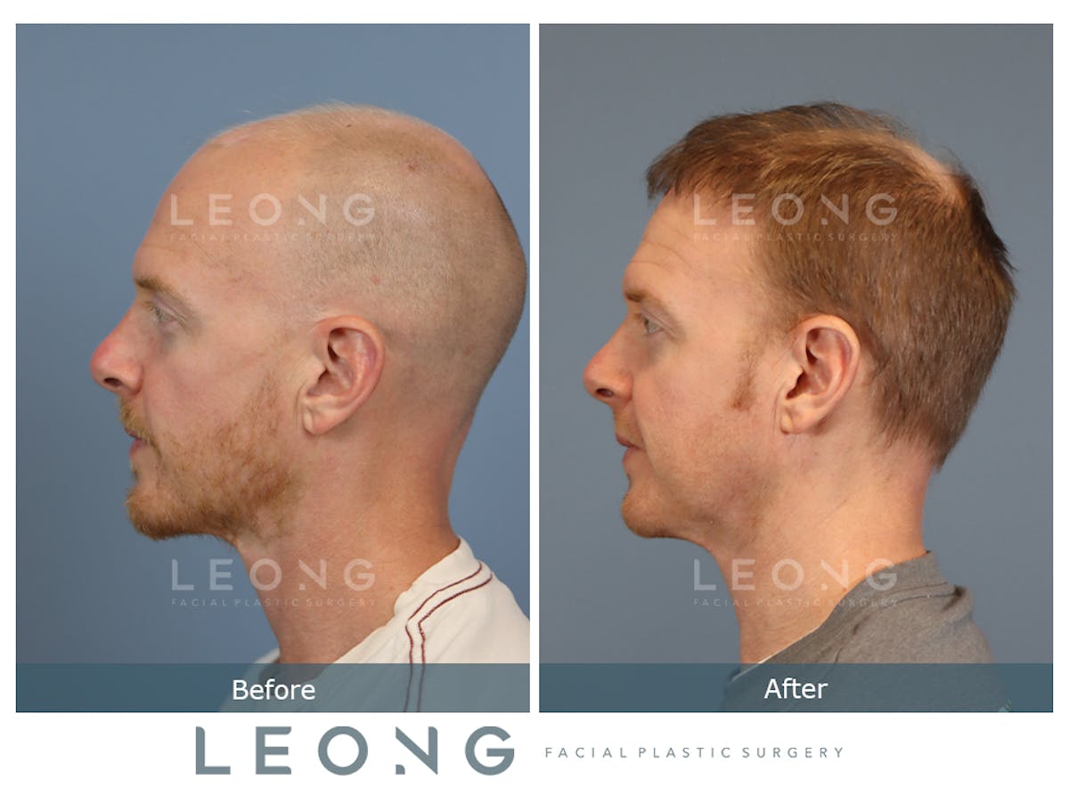Hair Transplant Before & After Gallery - Patient 334614 - Image 5