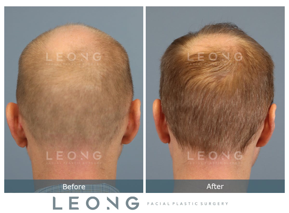 Hair Transplant Before & After Gallery - Patient 334614 - Image 7