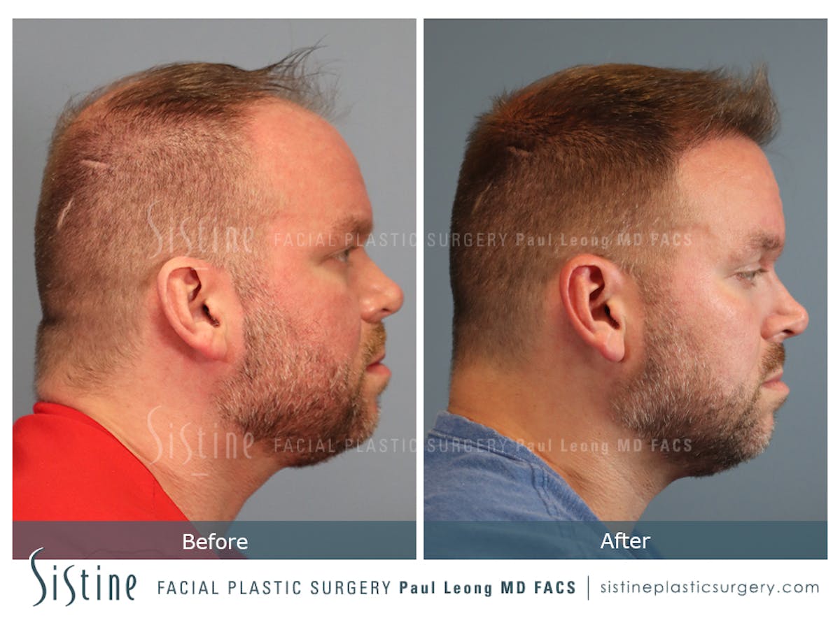 Hair Transplant Before & After Gallery - Patient 358755 - Image 1