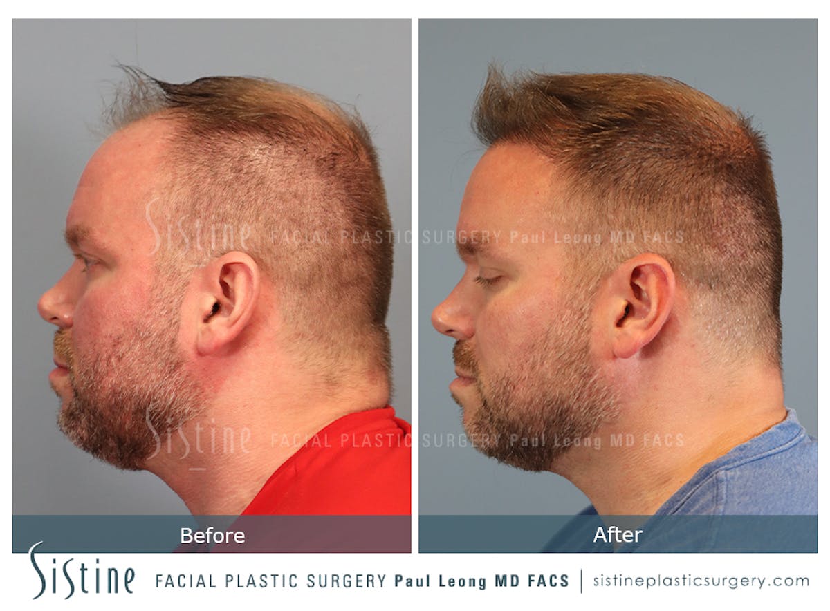 Hair Transplant Before & After Gallery - Patient 358755 - Image 3