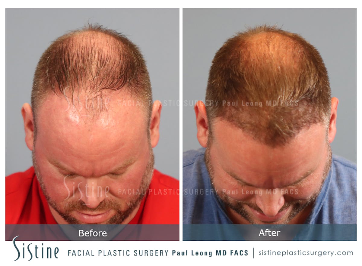 Hair Transplant Before & After Gallery - Patient 358755 - Image 4