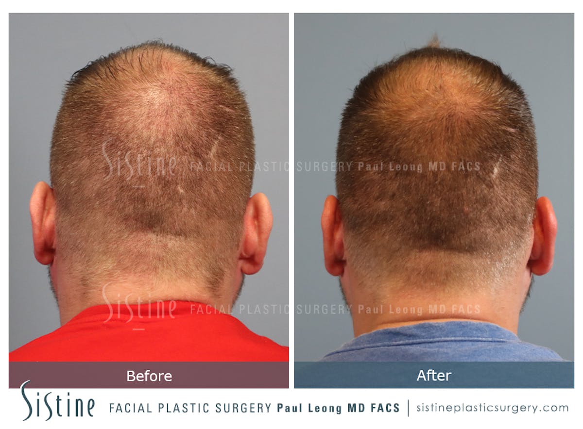 Hair Transplant Before & After Gallery - Patient 358755 - Image 5