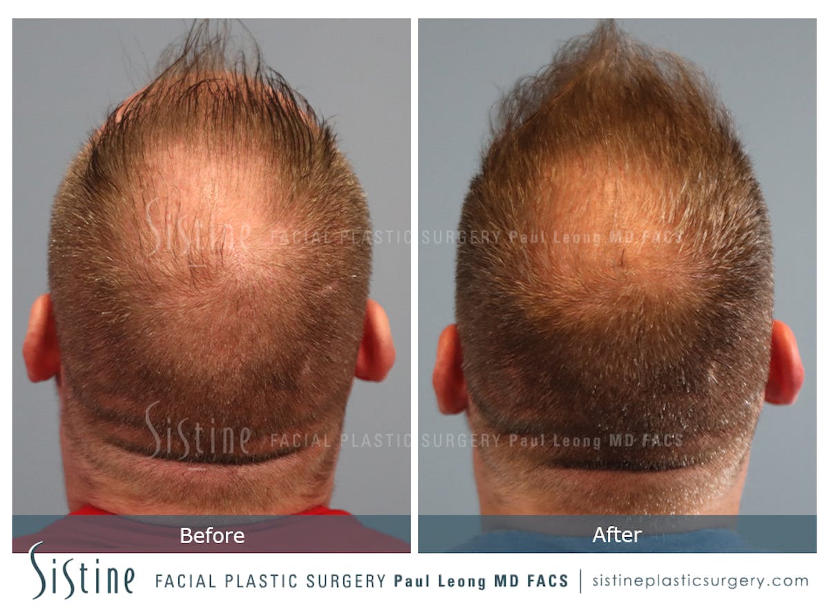 Hair Transplant Before & After Gallery - Patient 358755 - Image 6