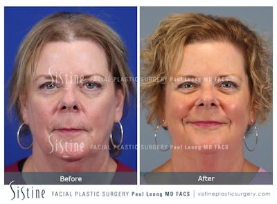 Hair Transplant Before & After Gallery - Patient 179837 - Image 1