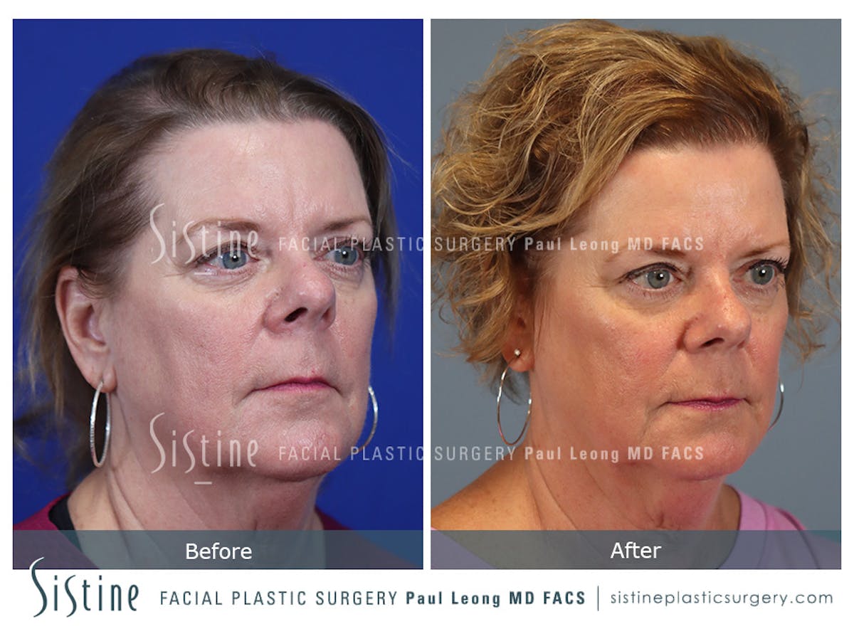 Hair Transplant Before & After Gallery - Patient 179837 - Image 2