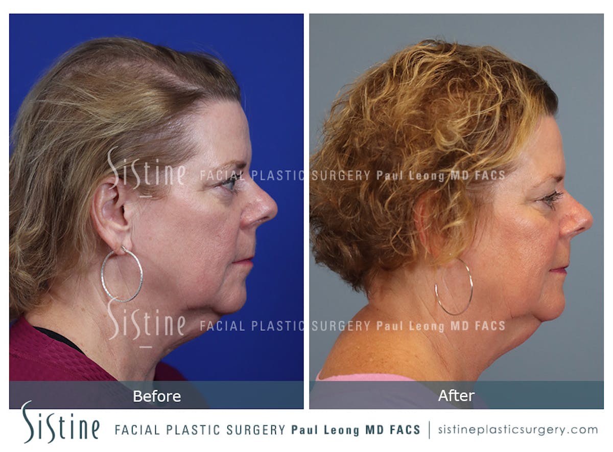 Hair Transplant Before & After Gallery - Patient 179837 - Image 3