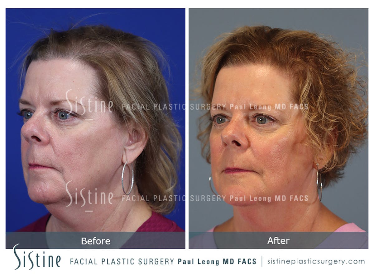 Hair Transplant Before & After Gallery - Patient 179837 - Image 4