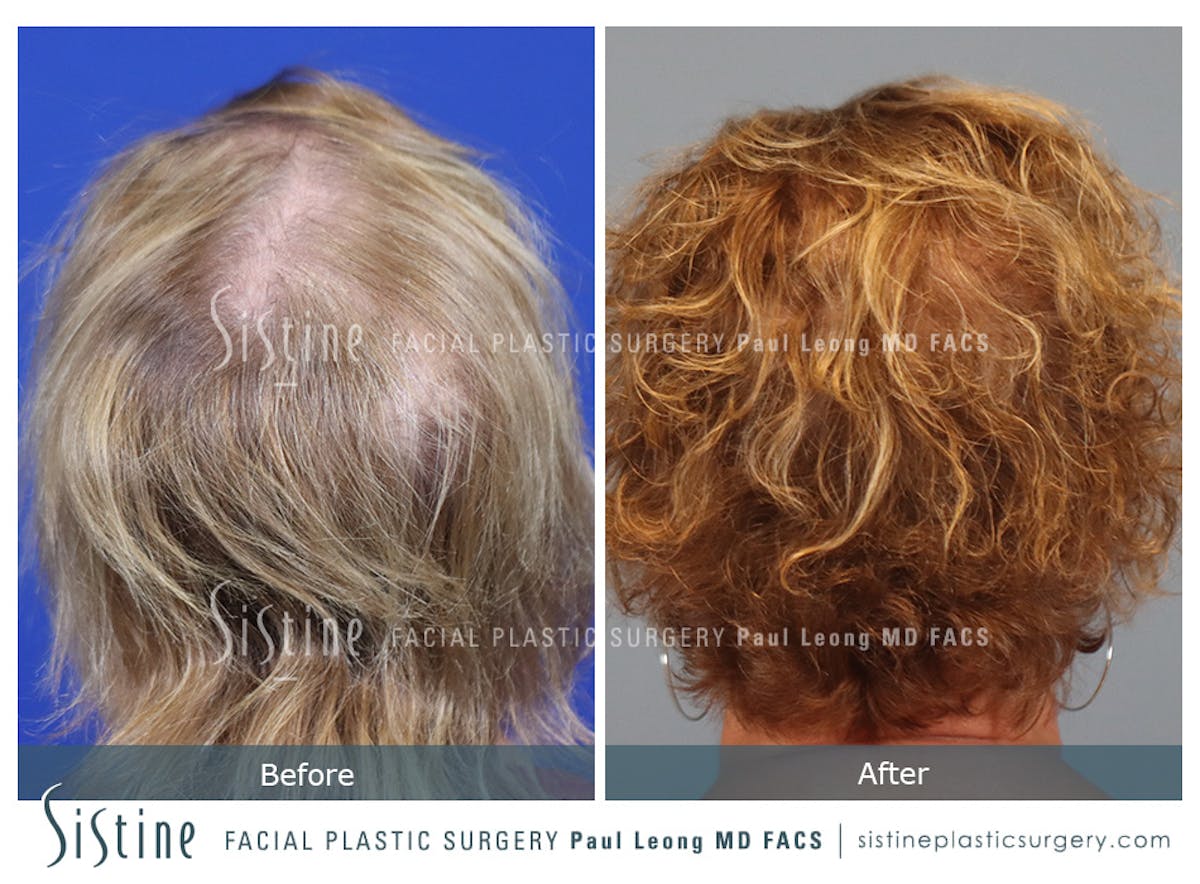 Hair Transplant Before & After Gallery - Patient 179837 - Image 7