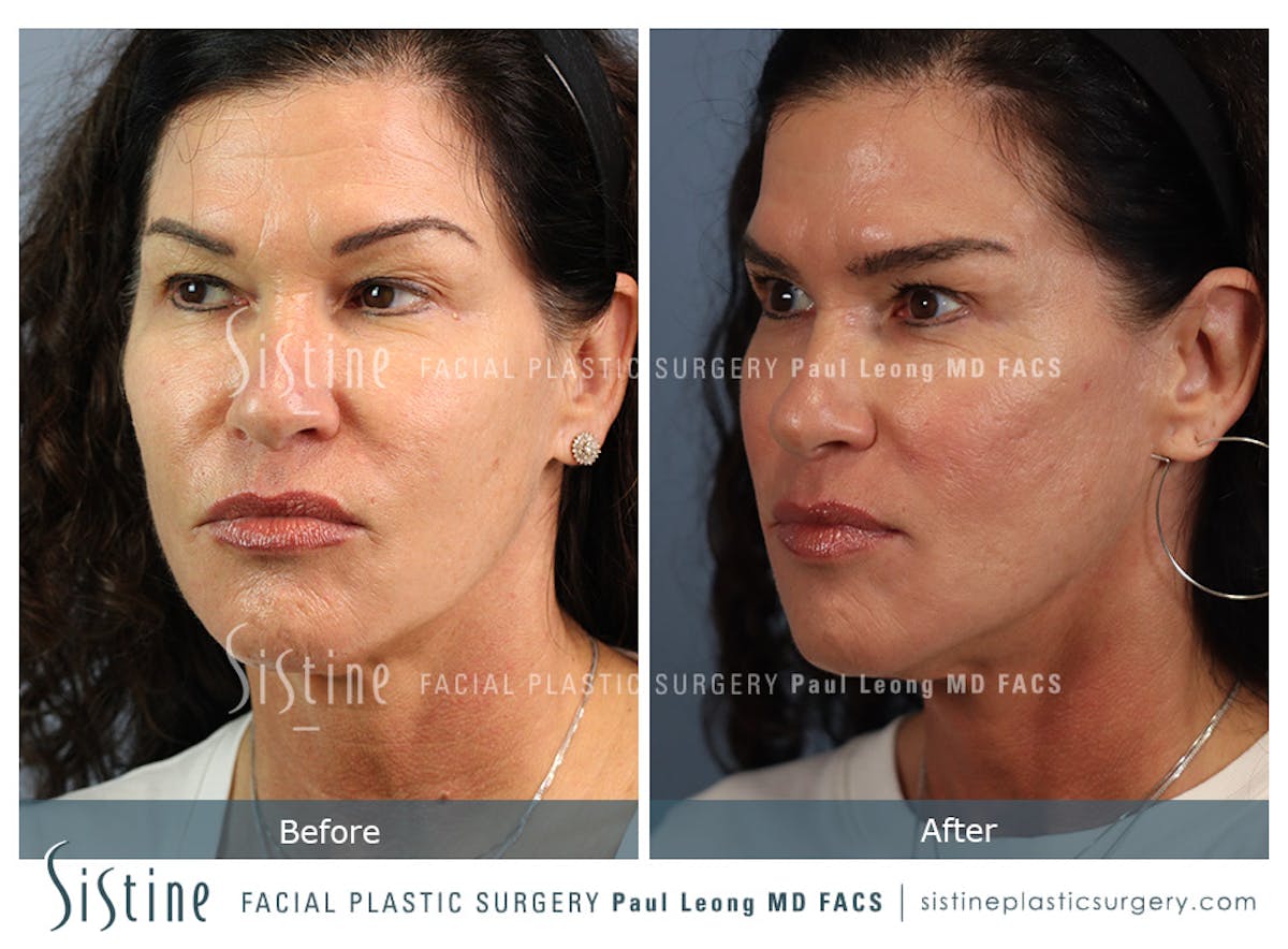 Hair Transplant Before & After Gallery - Patient 287111 - Image 3
