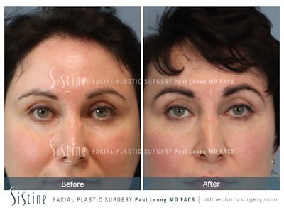 Hair Transplant Before & After Gallery - Patient 112607 - Image 1