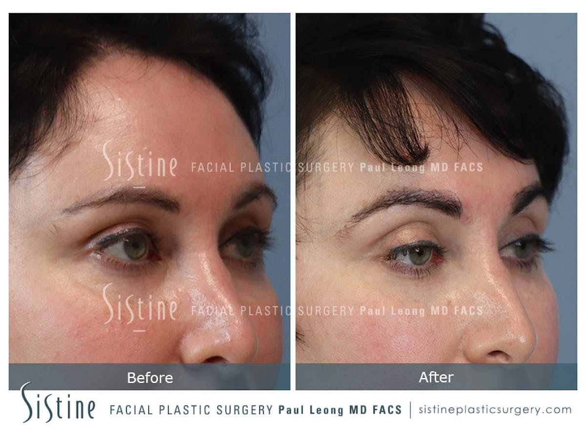 Hair Transplant Before & After Gallery - Patient 112607 - Image 2