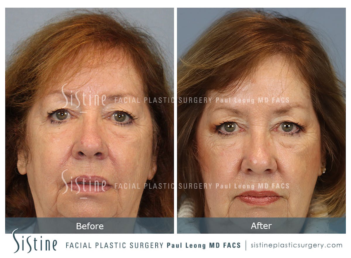 Hair Transplant Before & After Gallery - Patient 287607 - Image 2
