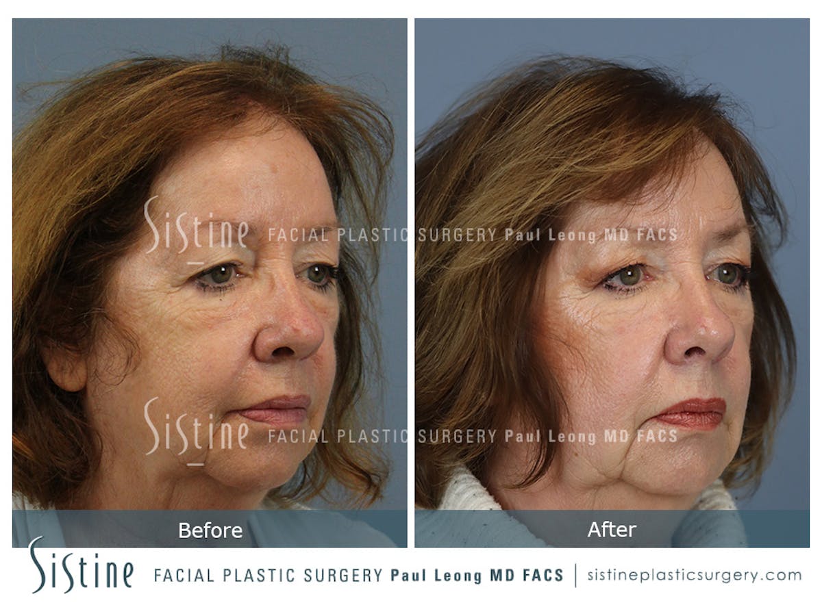 Hair Transplant Before & After Gallery - Patient 287607 - Image 3