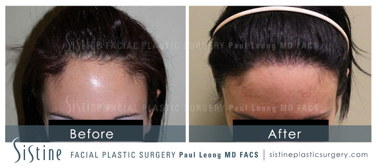 Hair Transplant Before & After Gallery - Patient 112346 - Image 1