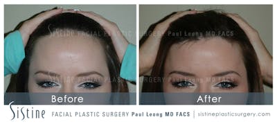 Hair Transplant Before & After Gallery - Patient 256063 - Image 1
