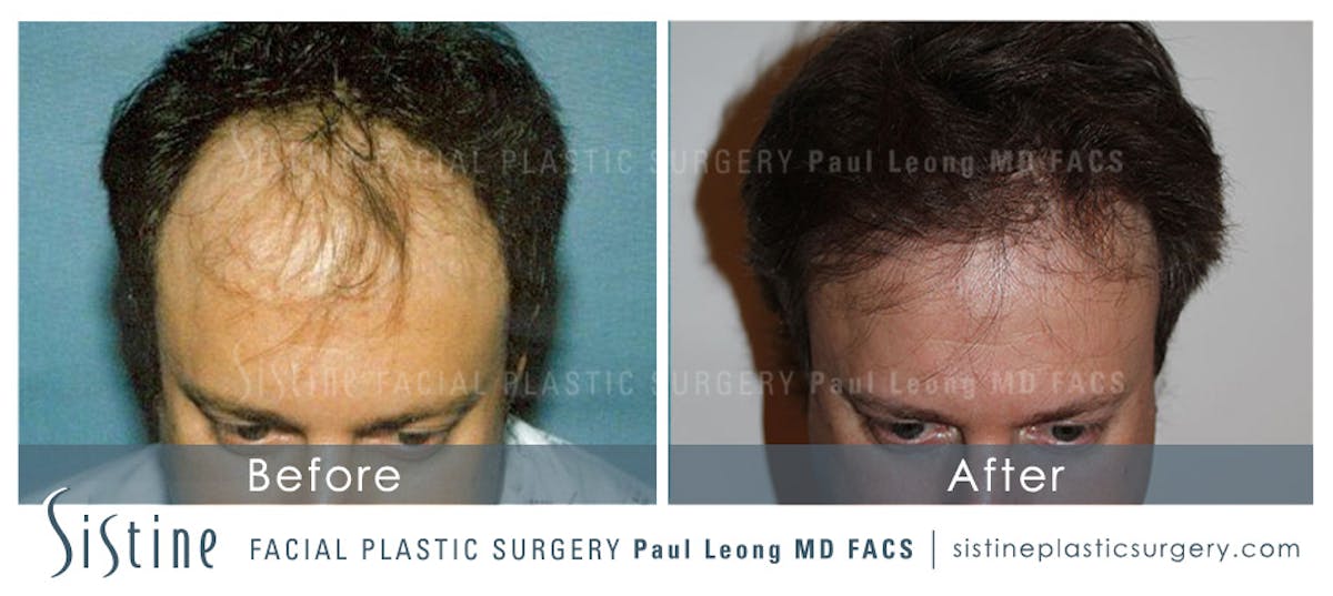 Hair Transplant Before & After Gallery - Patient 203168 - Image 1