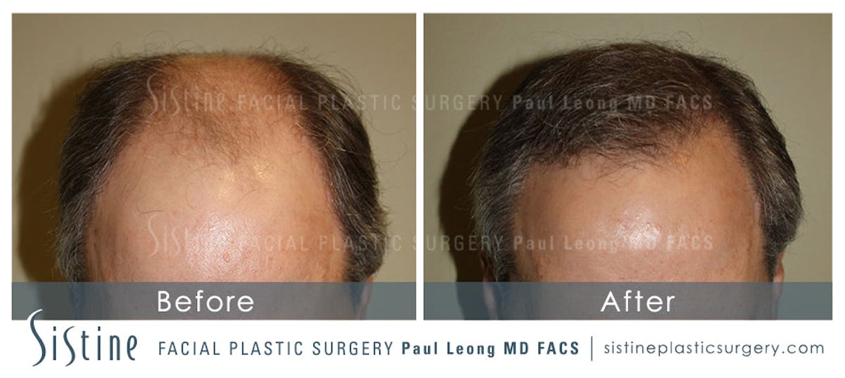 Hair Transplant Before & After Gallery - Patient 304923 - Image 1