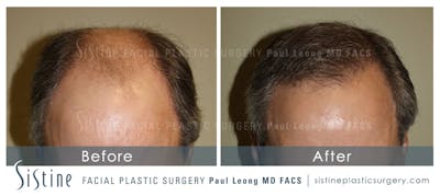 Hair Transplant Before & After Gallery - Patient 304923 - Image 1