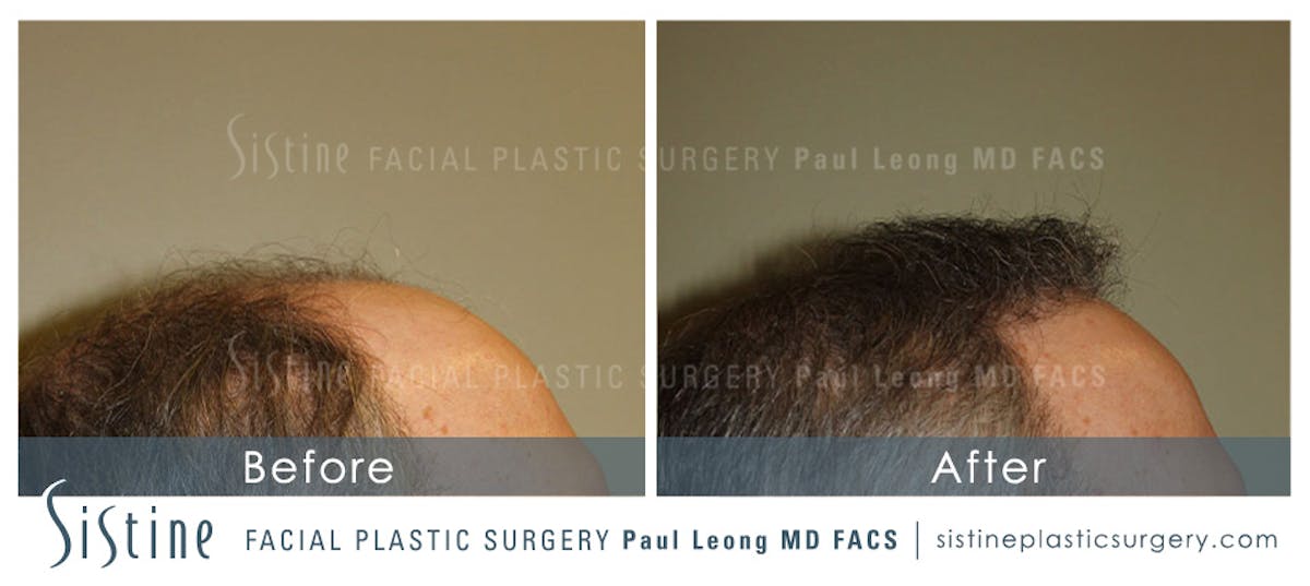 Hair Transplant Before & After Gallery - Patient 304923 - Image 3