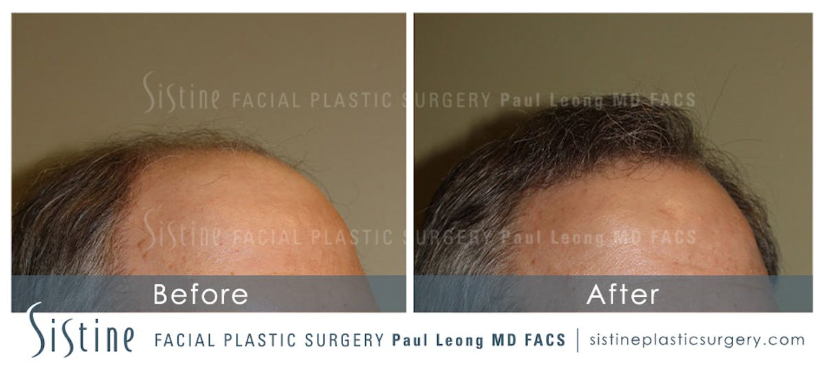 Hair Transplant Before & After Gallery - Patient 304923 - Image 4