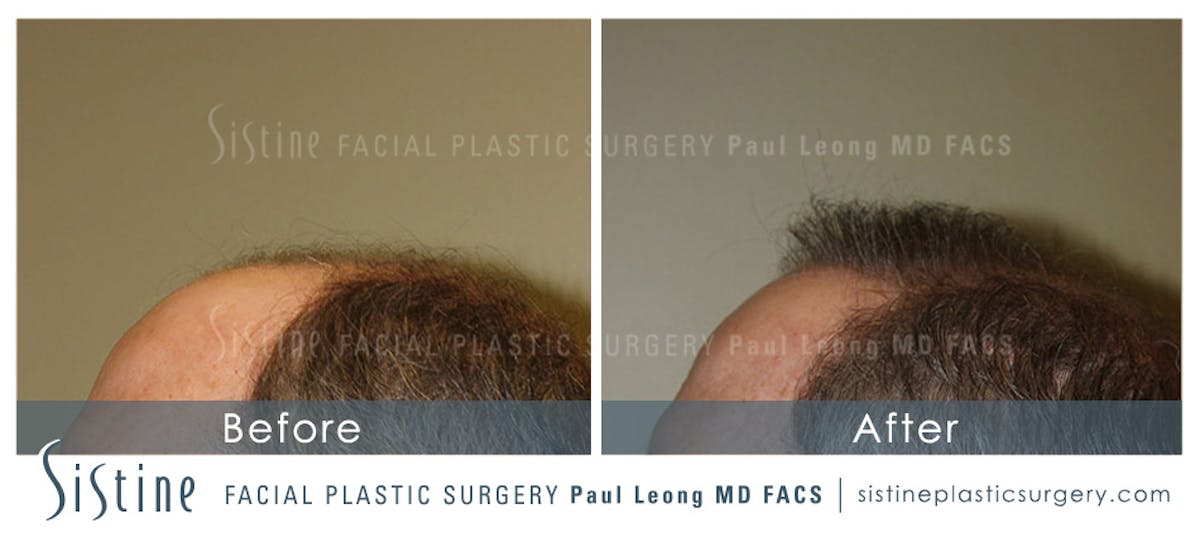 Hair Transplant Before & After Gallery - Patient 304923 - Image 5
