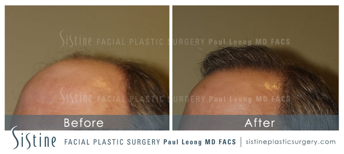 Hair Transplant Before & After Gallery - Patient 304923 - Image 6