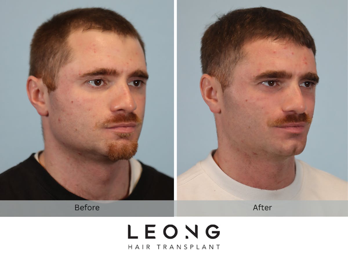 Hair Transplant Before & After Gallery - Patient 289044 - Image 7