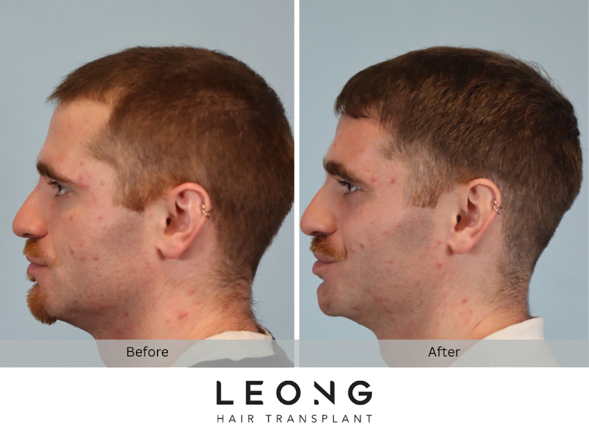 Hair Transplant Before & After Gallery - Patient 289044 - Image 3
