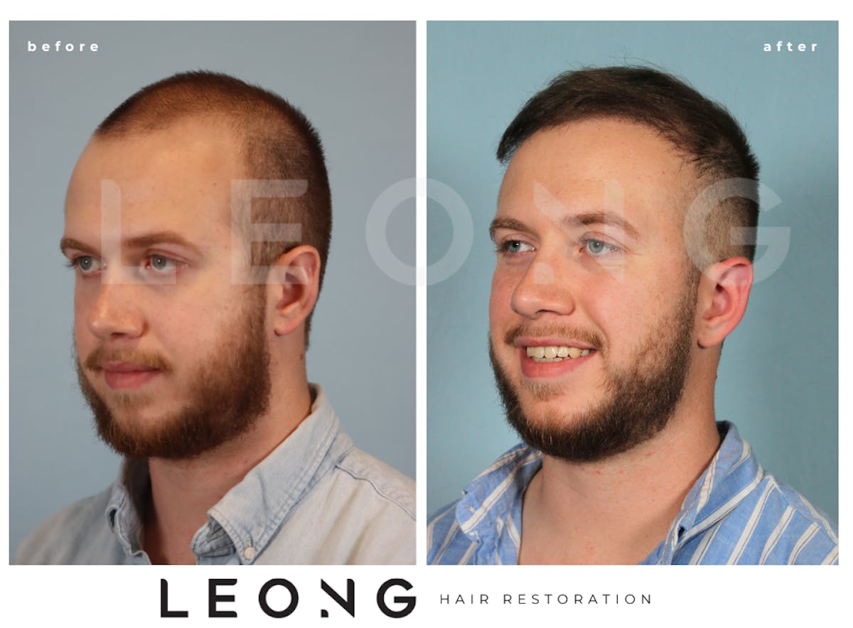 Hair Transplant Before & After Gallery - Patient 315110 - Image 2