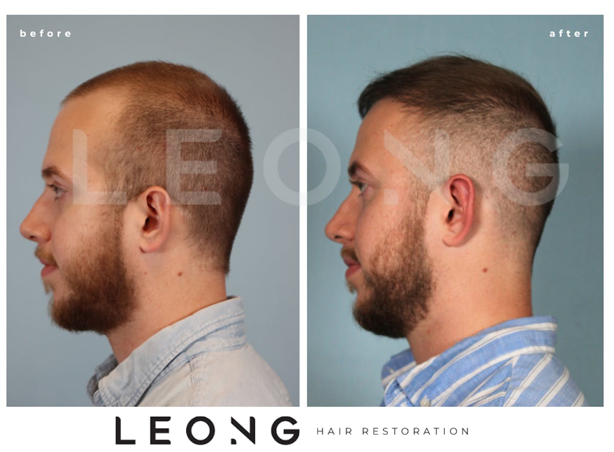 Hair Transplant Before & After Gallery - Patient 315110 - Image 4