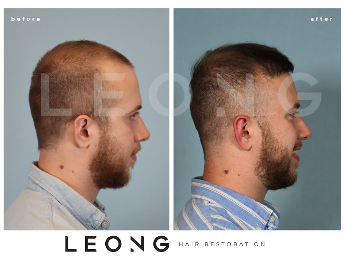 Hair Transplant Before & After Gallery - Patient 315110 - Image 3