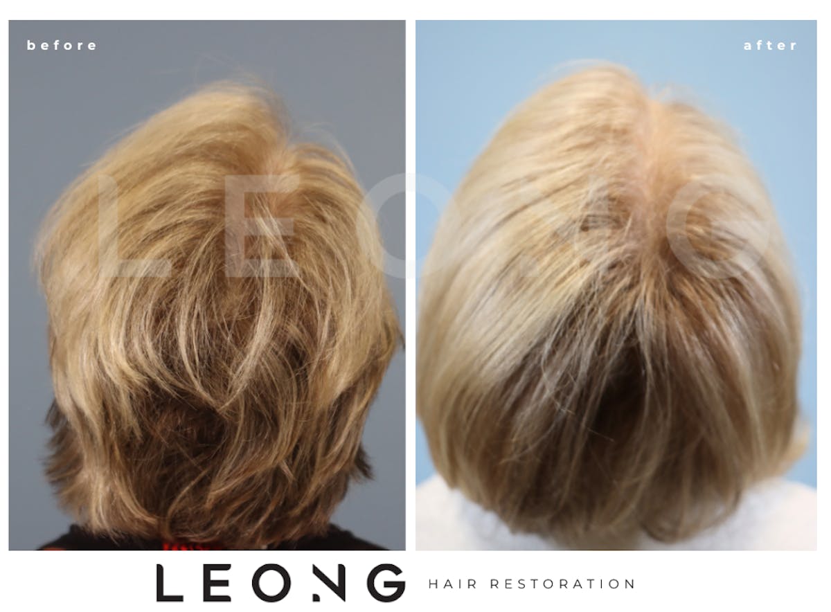 Hair Transplant Before & After Gallery - Patient 293900 - Image 7