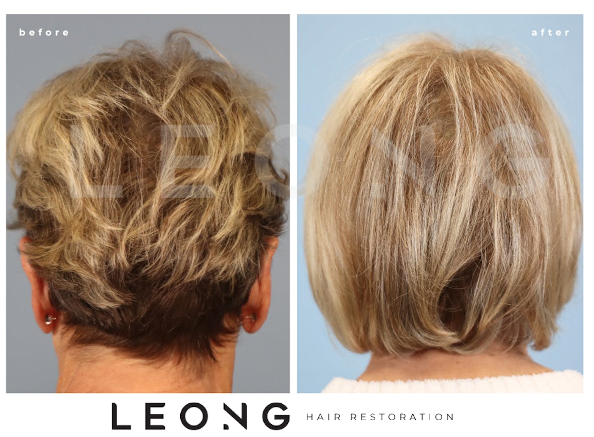 Hair Transplant Before & After Gallery - Patient 293900 - Image 3