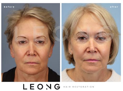 Hair Transplant Before & After Gallery - Patient 293900 - Image 1