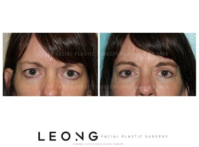 Blepharoplasty Before & After Gallery - Patient 130083 - Image 1