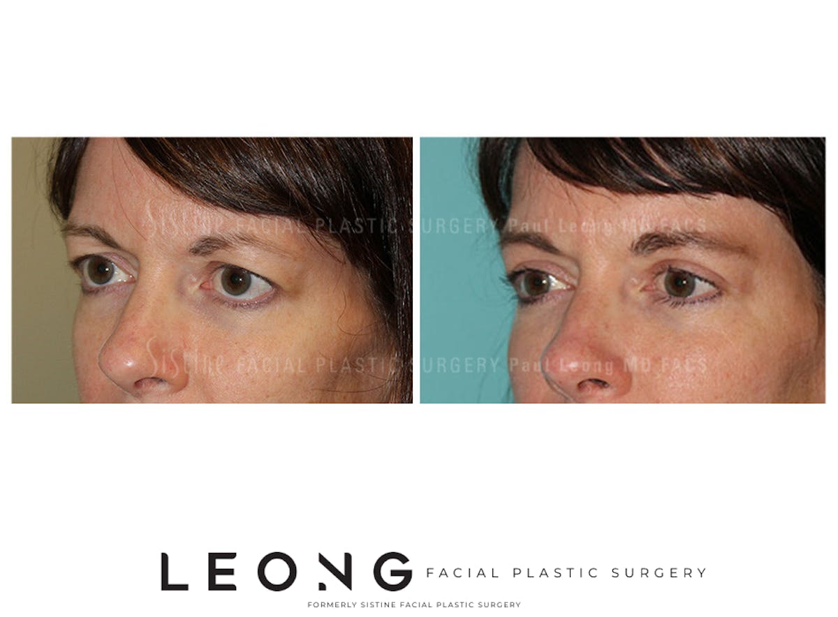 Eyes Before & After Gallery - Patient 370268 - Image 2