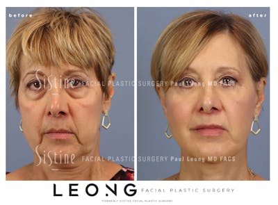 Blepharoplasty Before & After Gallery - Patient 125766 - Image 1
