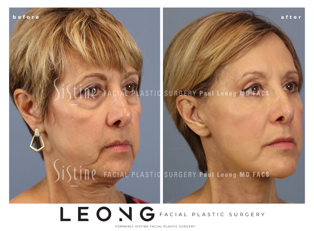 Facelift Before & After Gallery - Patient 371378 - Image 2