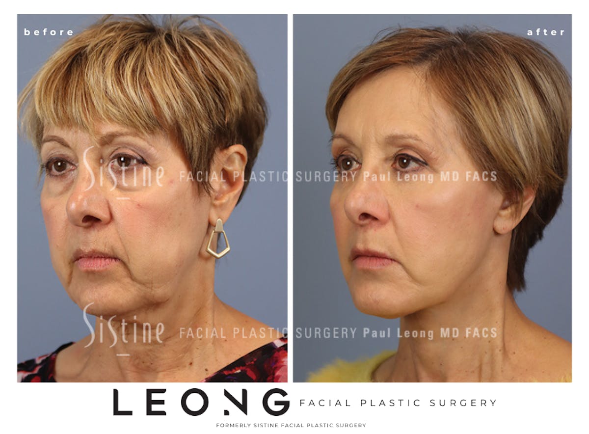Facelift Before & After Gallery - Patient 371378 - Image 3