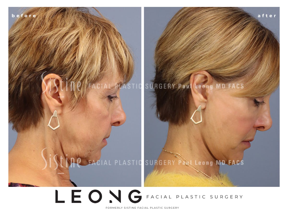 Facelift Before & After Gallery - Patient 371378 - Image 4