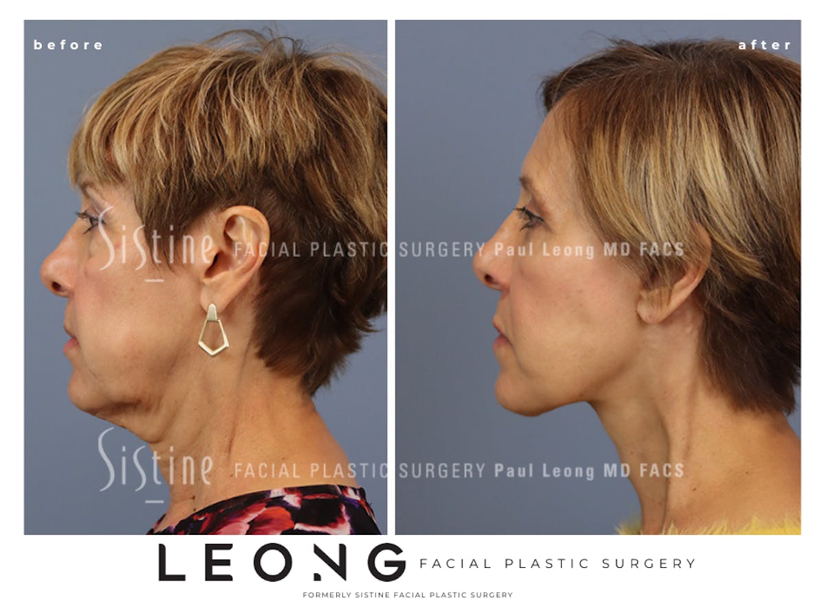 Facelift Before & After Gallery - Patient 371378 - Image 5