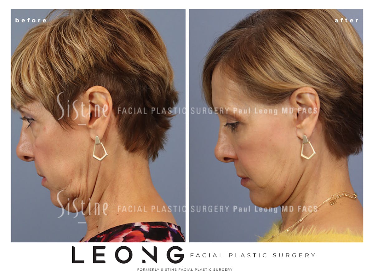 Facelift Before & After Gallery - Patient 371378 - Image 7