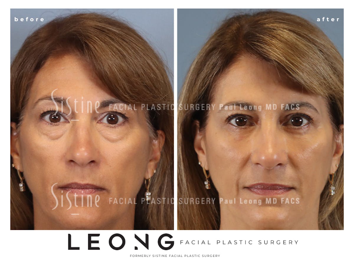 Blepharoplasty Before & After Gallery - Patient 365603 - Image 1