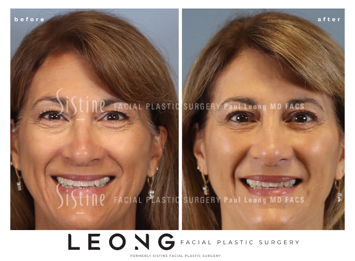 Blepharoplasty Before & After Gallery - Patient 365603 - Image 2