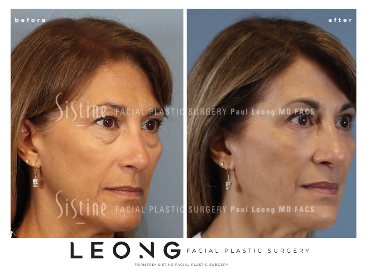 Blepharoplasty Before & After Gallery - Patient 365603 - Image 3
